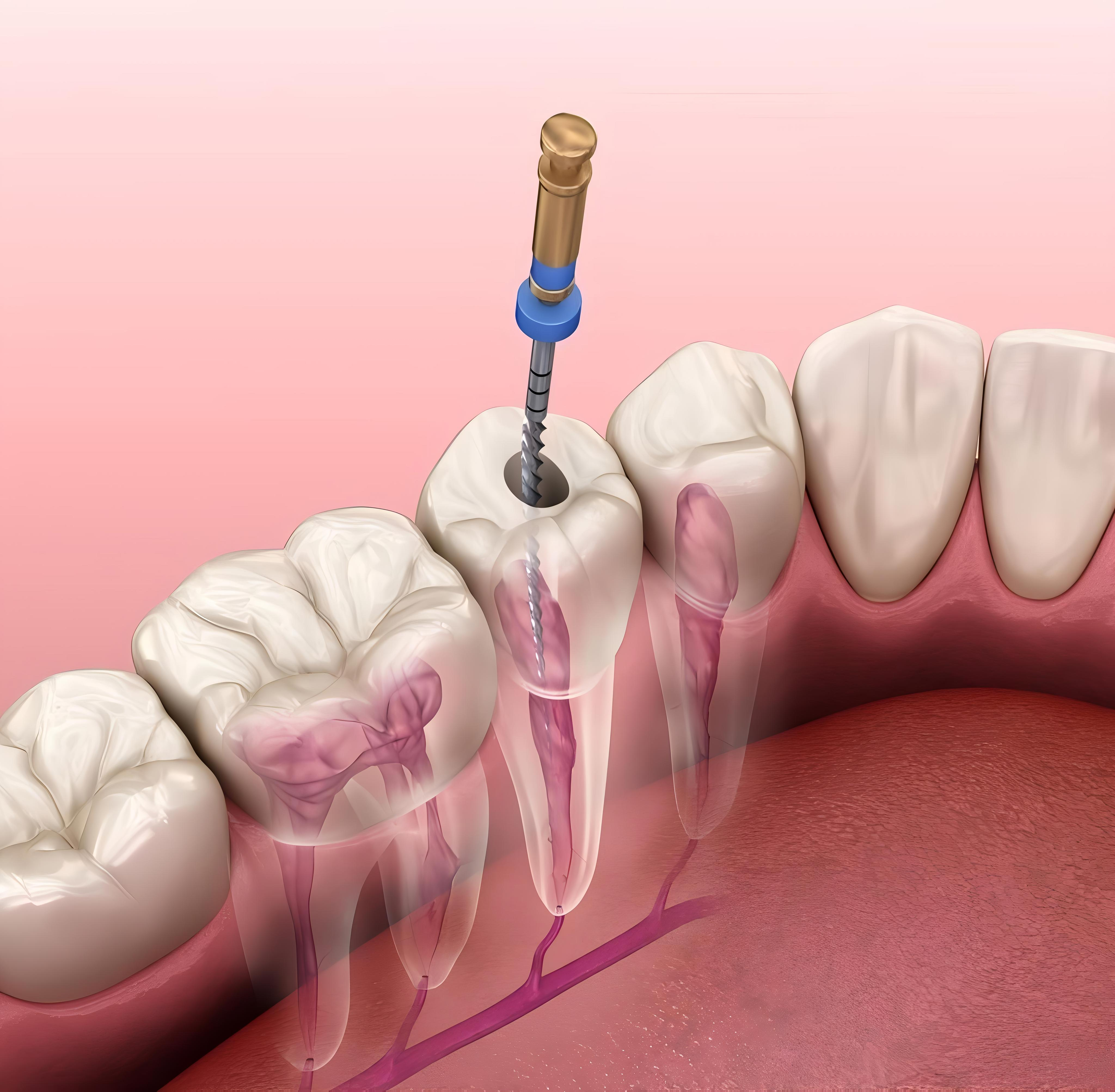 Endodontic Treatments